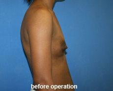 plastic-surgery-breast-augmentation